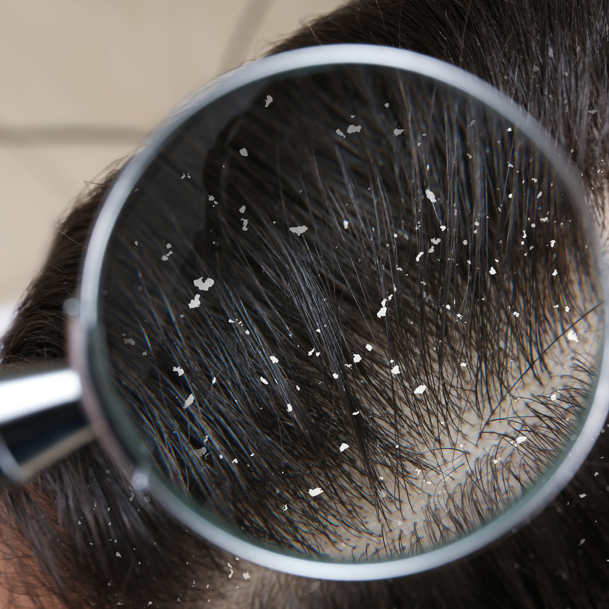 The Simple Ways to Dandruff-Free Hair - Simpelhaus